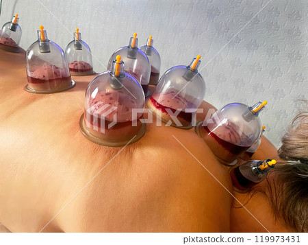 Cupping Therapy: The Ancient Art of Hijama Bloodletting. 119973431