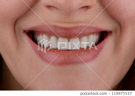 Female smile makeover by dental ceramic veneer, porcelain laminate veneers. 119975537