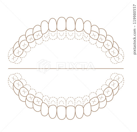 恆牙列期未拋光檢查表-染色插圖 恆牙列期未拋光檢查表-染色插圖 119980557