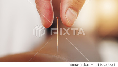 Acupuncture, needles and skin with hand in closeup, alternative medicine or healing therapy. Relax, muscle and body pain in clinic for health or wellness, support for immune system or stress injury Acupuncture, needles and skin with hand in closeup, alternative medicine or healing therapy. Relax, muscle and body pain in clinic for health or wellness, support for immune system or stress injury 119988281