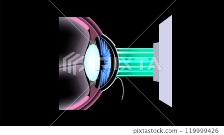 LASIK eye surgery 119999426