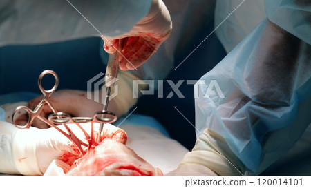 Close up of surgical tools being used by surgeons during a complex operation, highlighting the precision and expertise required in the medical field 120014101