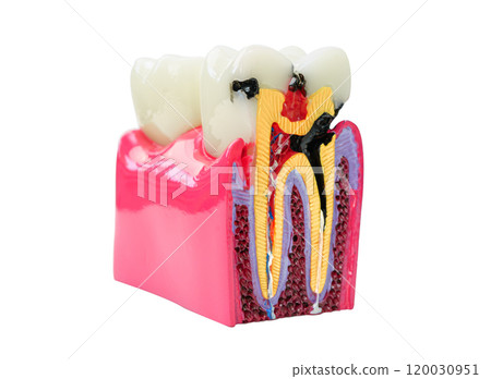 Dental implant, artificial tooth roots into jaw human model isolated on white background with clipping path. Dental implant, artificial tooth roots into jaw human model isolated on white background with clipping path. 120030951