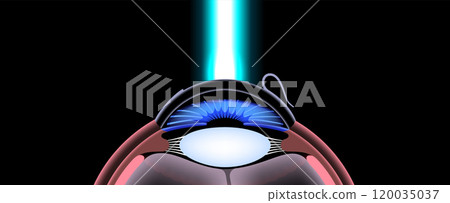 LASIK eye surgery LASIK eye surgery 120035037
