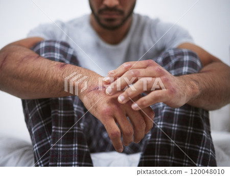 Man, sad and hand scratch for depression, anxiety and trauma as patient with fear, scar and paranoid. Male person, ptsd and violence with mental health, psychosis and personality disorder for mind Man, sad and hand scratch for depression, anxiety and trauma as patient with fear, scar and paranoid. Male person, ptsd and violence with mental health, psychosis and personality disorder for mind 120048010
