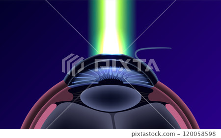 LASIK eye surgery 120058598