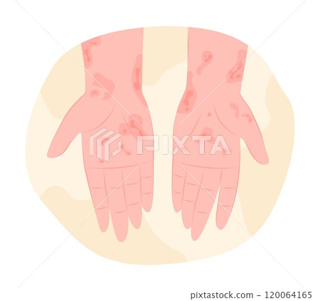 Eczema or Skin Rashes on Human Hands for Dermatology Concept Illustration 120064165