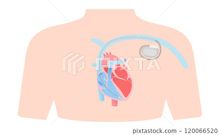 附著在心臟上的起搏器的插圖 附著在心臟上的起搏器的插圖 120066520