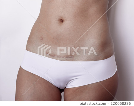 Post surgery recovery. Womans midsection with c section scar highlighting healing process 120068226