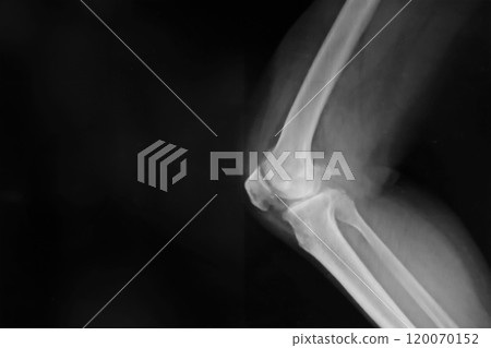 Black and white X-ray film of the knee and leg. 120070152
