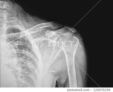 Black and white X-ray film of the shoulder and arm. 120070199