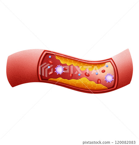 Atherosclerosis and blood flow illustration by... - Stock Illustration ...