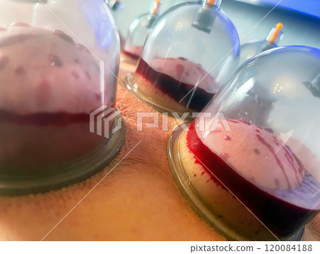 Cupping Therapy: The Ancient Art of Hijama Bloodletting. 120084188