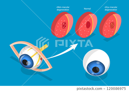 3D Isometric Flat Vector Illustration of Age-related Macular Degeneration, Eye Illness, Sight Problem 3D Isometric Flat Vector Illustration of Age-related Macular Degeneration, Eye Illness, Sight Problem 120086975