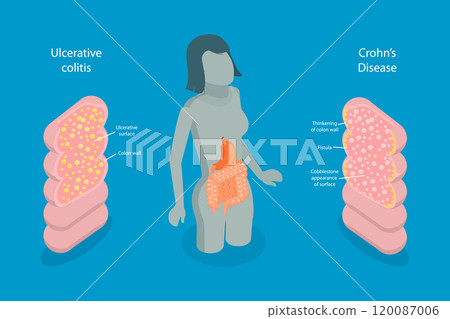 3D Isometric Flat Vector Illustration of IBD, Educational Diagram for Inflammatory Bowel Disease 120087006