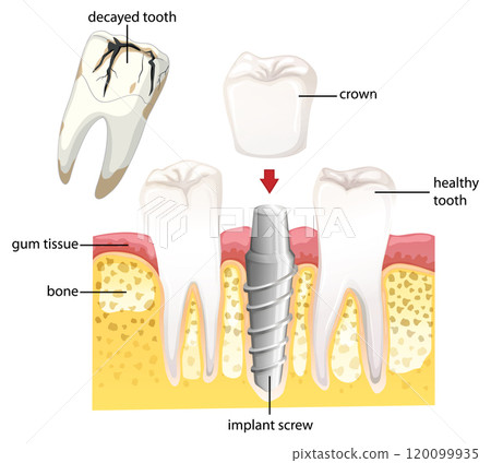 Dental Implant Procedure Illustration Dental Implant Procedure Illustration 120099935