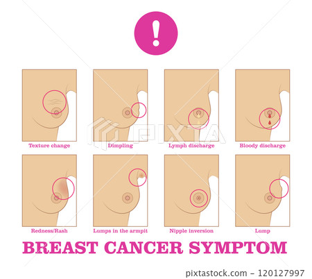 Breast cancer symptom Breast cancer symptom 120127997