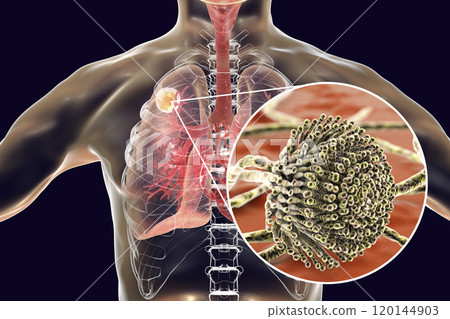 Aspergilloma of the lung Aspergilloma of the lung 120144903