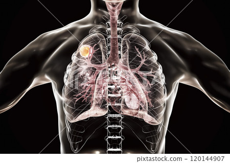 Aspergilloma of the lung Aspergilloma of the lung 120144907