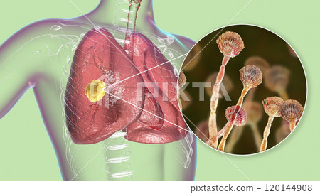 Pulmonary aspergillosis, invasion of a lung tissue by mold fungi Aspergillus with closeup view of the fungi, 3D illustration 120144908