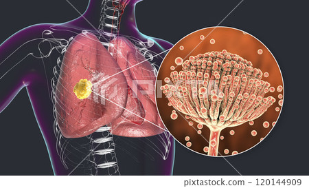 Pulmonary aspergillosis, invasion of a lung tissue by mold fungi Aspergillus with closeup view of the fungi, 3D illustration 120144909