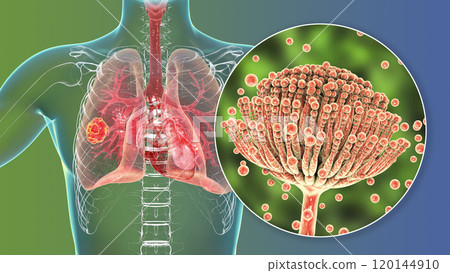 Pulmonary aspergillosis, invasion of a lung tissue by mold fungi Aspergillus with closeup view of the fungi, 3D illustration 120144910
