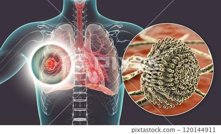 Pulmonary aspergillosis, invasion of a lung tissue by mold fungi Aspergillus with closeup view of the fungi, 3D illustration Pulmonary aspergillosis, invasion of a lung tissue by mold fungi Aspergillus with closeup view of the fungi, 3D illustration 120144911