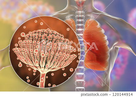 Pulmonary aspergillosis, invasion of a lung tissue by mold fungi Aspergillus with closeup view of the fungi, 3D illustration Pulmonary aspergillosis, invasion of a lung tissue by mold fungi Aspergillus with closeup view of the fungi, 3D illustration 120144914