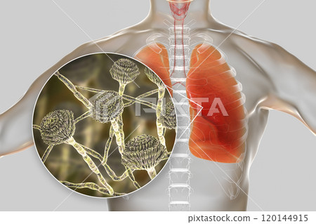 Pulmonary aspergillosis, invasion of a lung tissue by mold fungi Aspergillus with closeup view of the fungi, 3D illustration Pulmonary aspergillosis, invasion of a lung tissue by mold fungi Aspergillus with closeup view of the fungi, 3D illustration 120144915