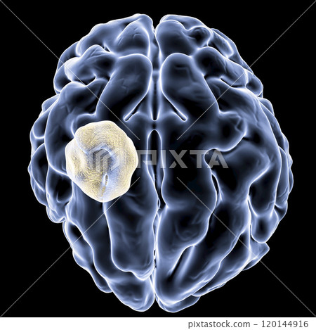 Aspergilloma of the brain 120144916
