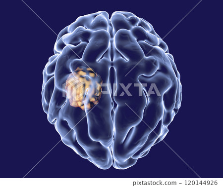 Aspergilloma of the brain Aspergilloma of the brain 120144926