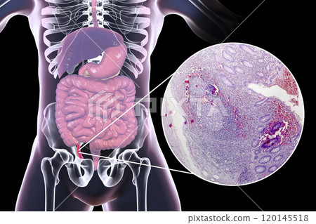 Chronic appendicitis, illustration and light micrograph 120145518