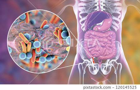 Acute appendicitis illustration Acute appendicitis illustration 120145525