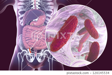 Acute appendicitis illustration 120145534