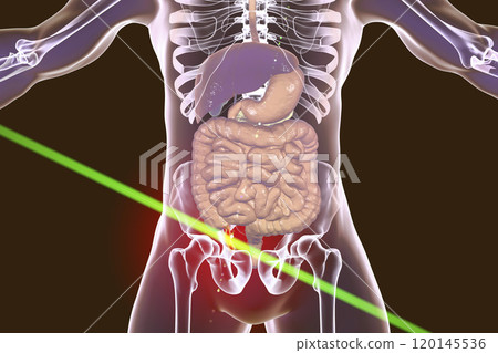 Acute appendicitis illustration 120145536