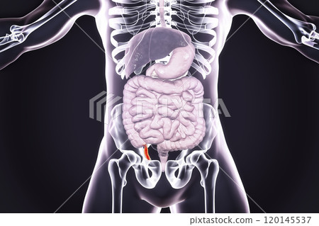 Acute appendicitis illustration 120145537