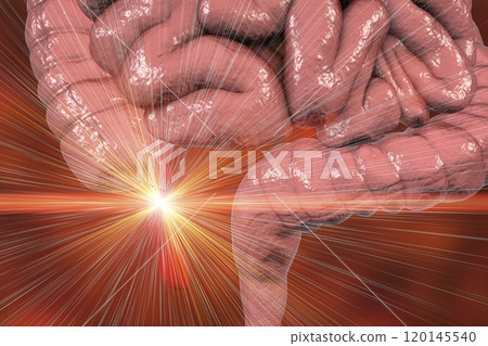 Acute appendicitis illustration 120145540