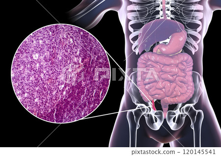 Acute appendicitis, illustration and light micrograph 120145541