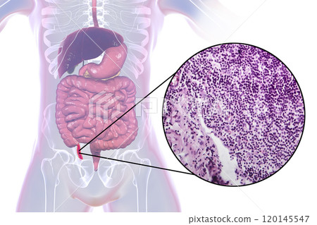 Acute appendicitis, illustration and light micrograph 120145547