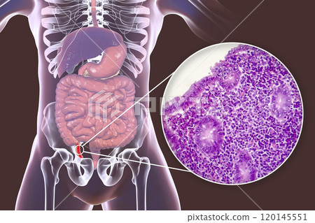 Acute suppurative appendicitis, illustration and light micrograph Acute suppurative appendicitis, illustration and light micrograph 120145551