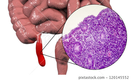 Acute suppurative appendicitis, illustration and light micrograph 120145552