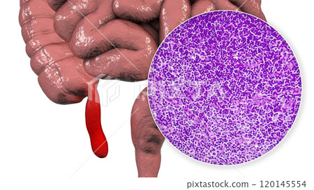Acute suppurative appendicitis, illustration and light micrograph 120145554