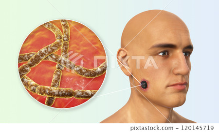 Cutaneous anthrax, the most common form of anthrax 120145719