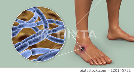 Cutaneous anthrax, the most common form of anthrax 120145731