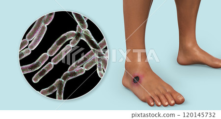 Cutaneous anthrax, the most common form of anthrax 120145732