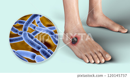 Cutaneous anthrax, the most common form of anthrax Cutaneous anthrax, the most common form of anthrax 120145737