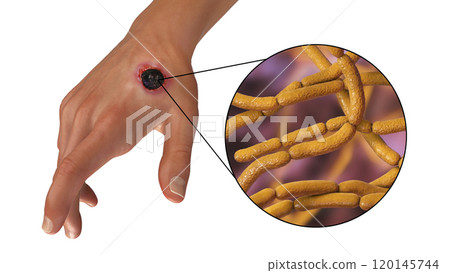Cutaneous anthrax, the most common form of anthrax 120145744