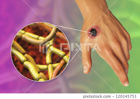 Cutaneous anthrax, the most common form of anthrax 120145751