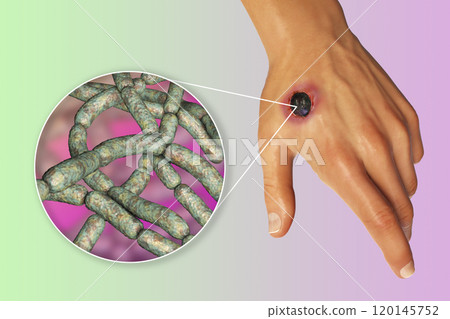 Cutaneous anthrax, the most common form of anthrax Cutaneous anthrax, the most common form of anthrax 120145752