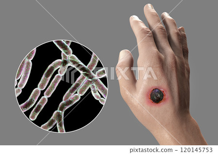 Cutaneous anthrax, the most common form of anthrax Cutaneous anthrax, the most common form of anthrax 120145753